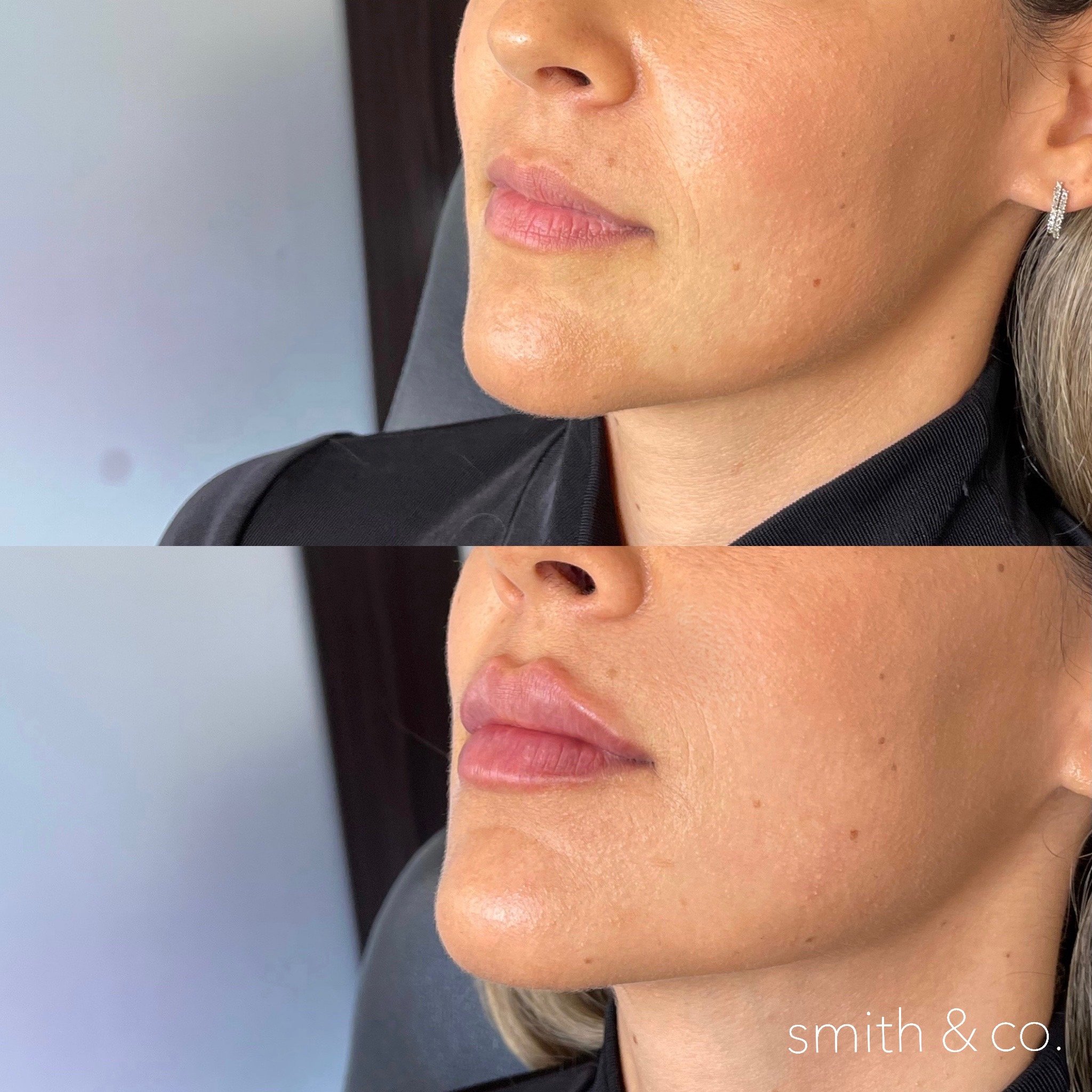 smith & co best lip fillers and PDO threads in miami, ashton technique, russian technique_6580.JPG