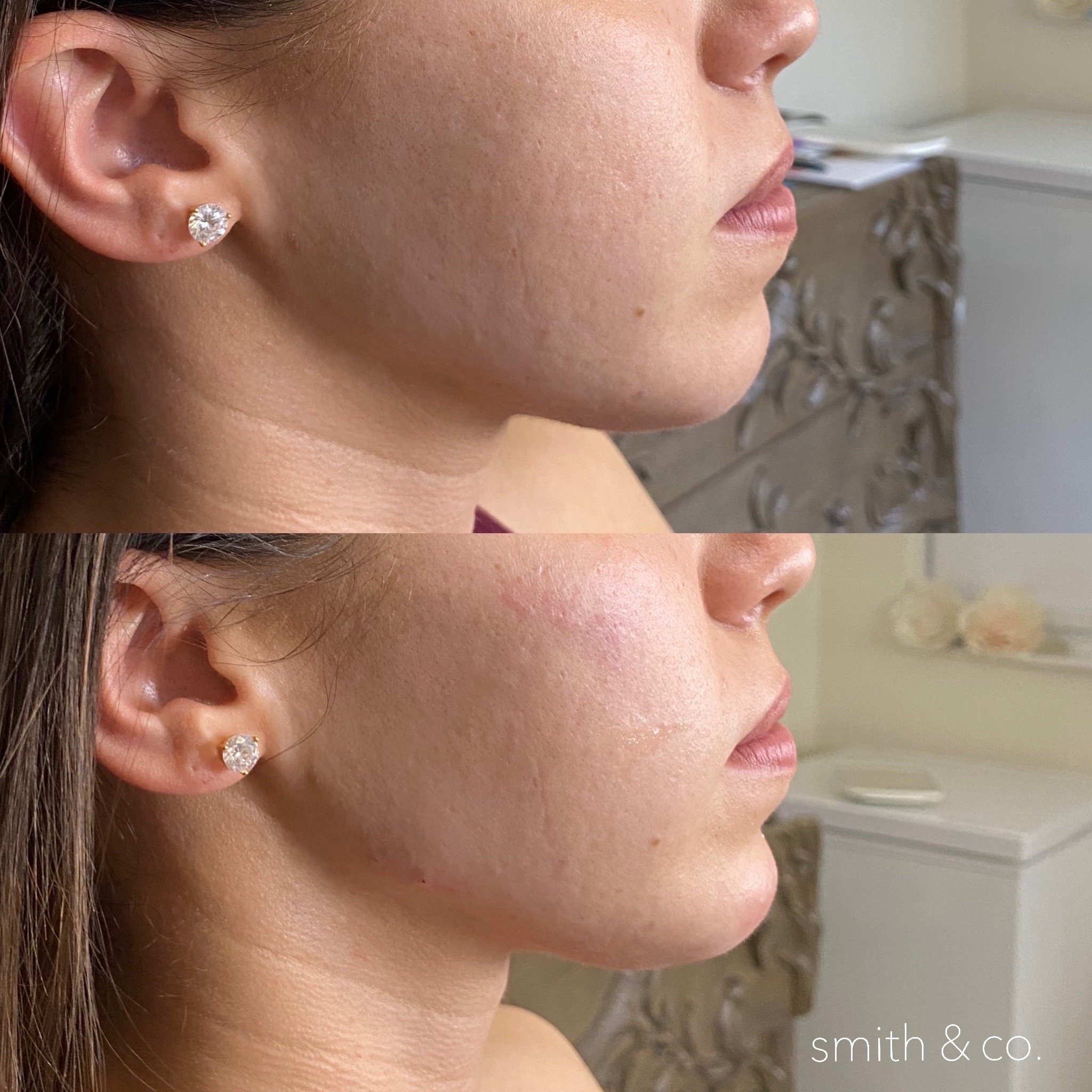 cheek and jawline contour with filler