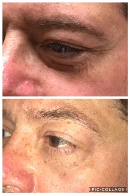 8 days post procedure (top- before, bottom- after)