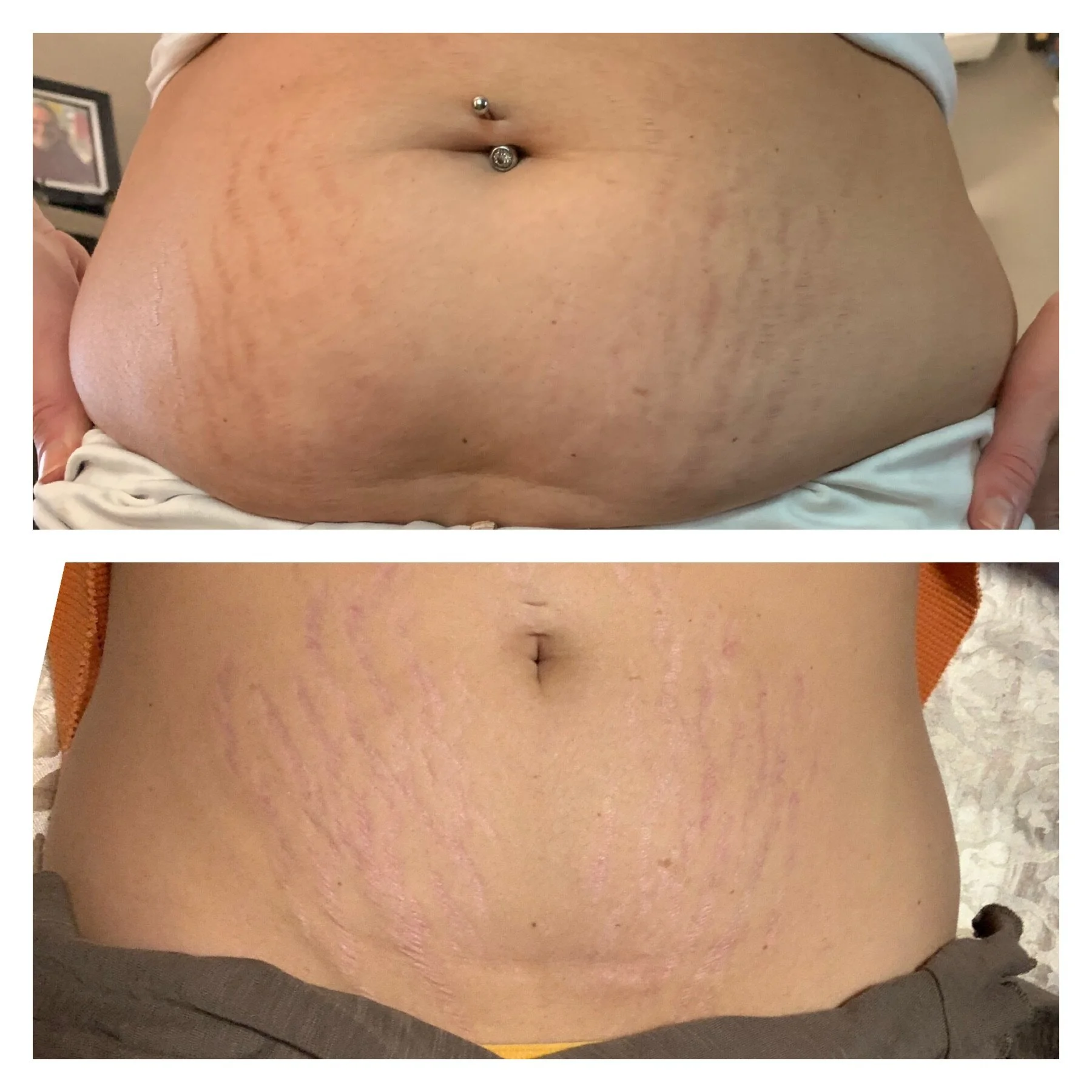 Fibroblast Plasma Lift — Portage Hair Salon and Spa - Moxie Salon & Spa