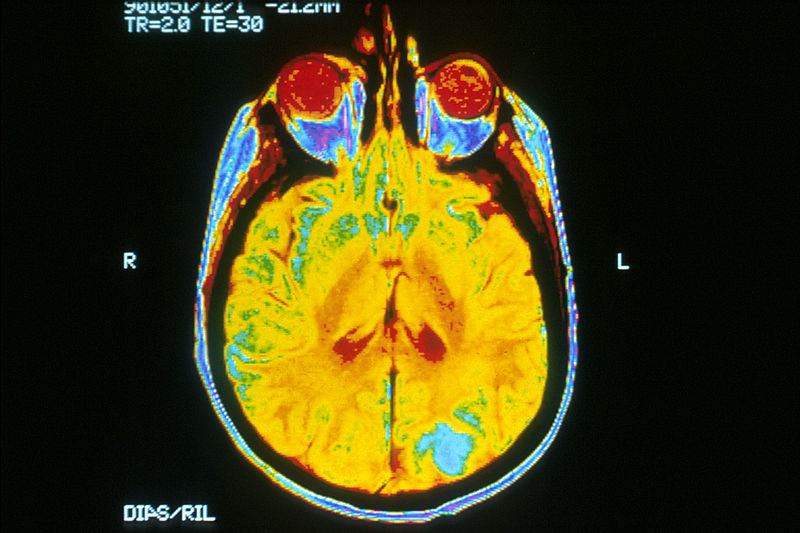 MRI Scan Via Wikimedia Commons