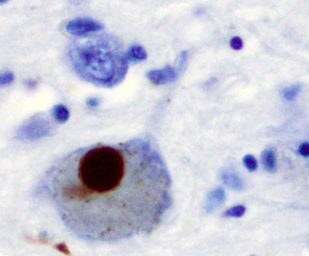 A Lewy body (stained brown) in Parkinson's disease. Via Wikimedia Commons 