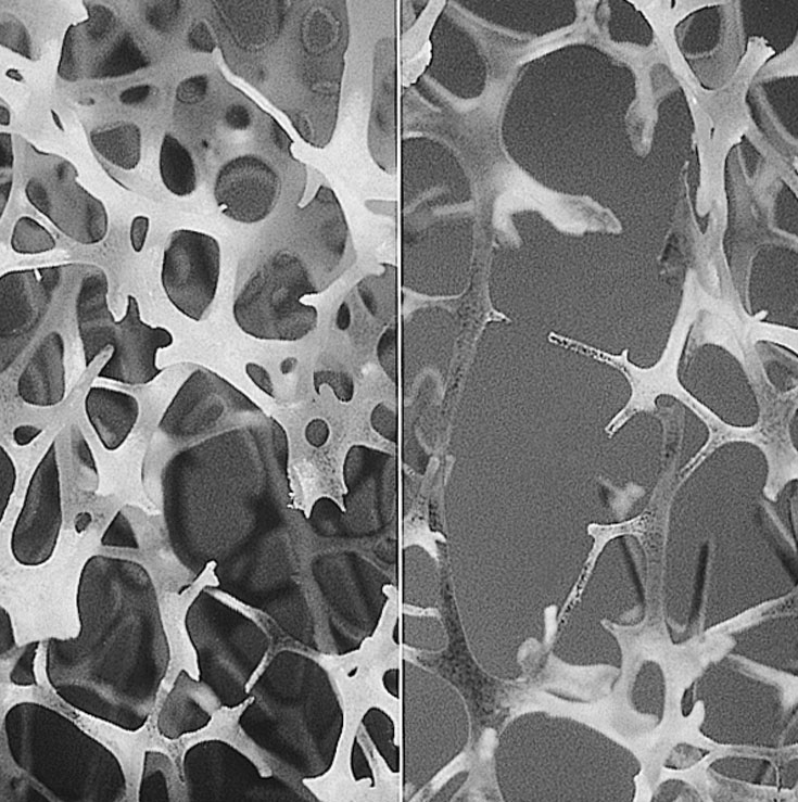 Microarchitecture of healthy bone (left) and in osteoporosis (right) via Wikimedia Commons