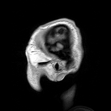 MRI of the head in a patient with benign familial macrocephaly. (Source: Wikimedia Commons)