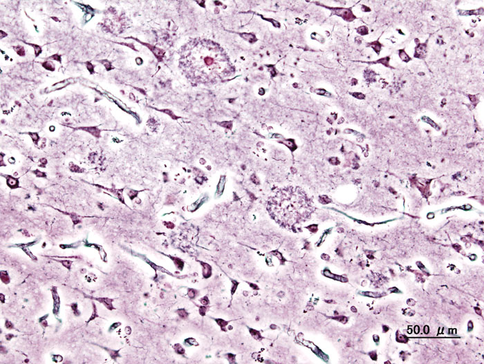 The senile plaques seen in the cerebral cortex of a person with Alzheimer's disease of presenile onset. 