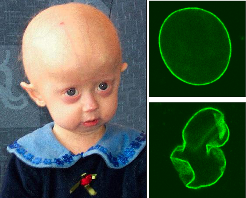 A young girl with progeria (left). A deformed cell nucleus present in the condition (right, bottom)