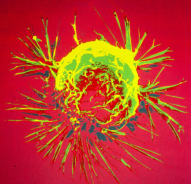 Breast cancer cell Credit: National Cancer Institute