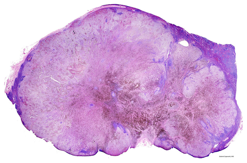 A lymph node being replaced by metastatic melanoma. 
