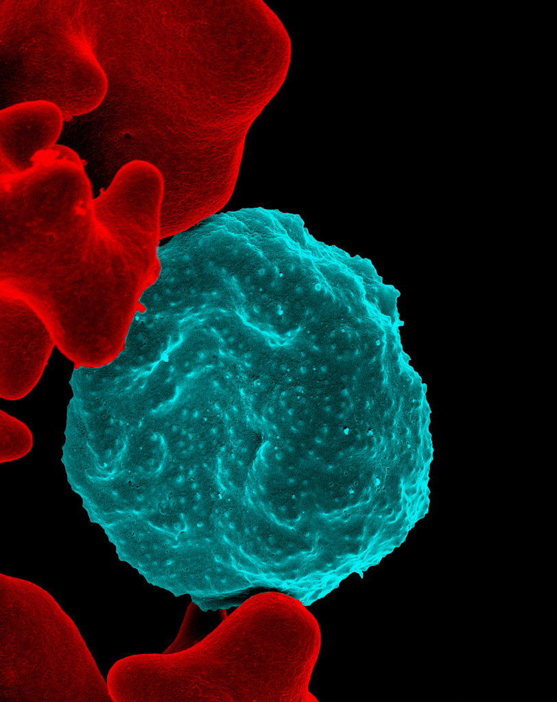Malaria infected red blood cell. Credit: NIAID