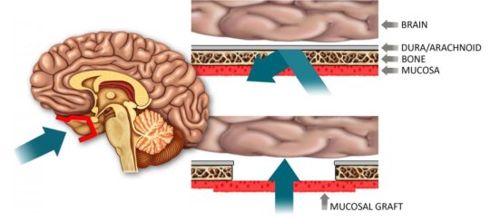 Drugs can be administered through the nose and diffused through a mucosal graft (A, red) which is 1,000 times more porous than the normal blood-brain barrier. Credit: Garyfallia Pagonis and Benjamin S. Bleier, M.D.