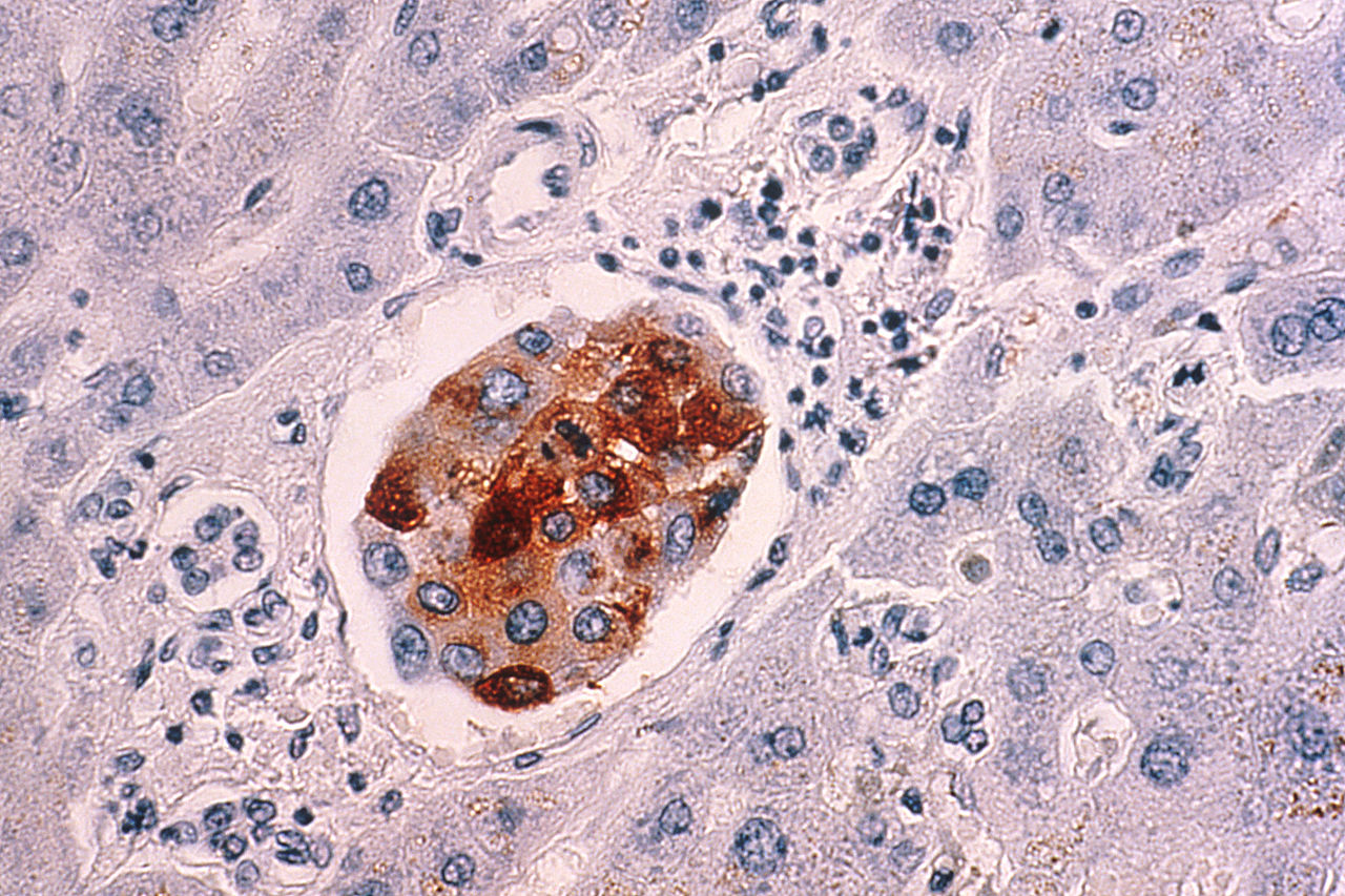 Breast cancer metastasis in the liver