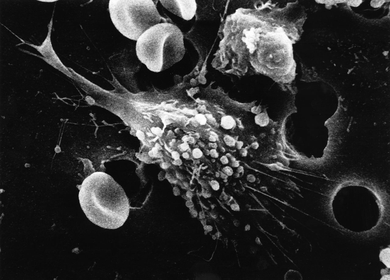 A cancer cell dying. Credit: Dr. Raowf Guirguis. National Cancer Institute