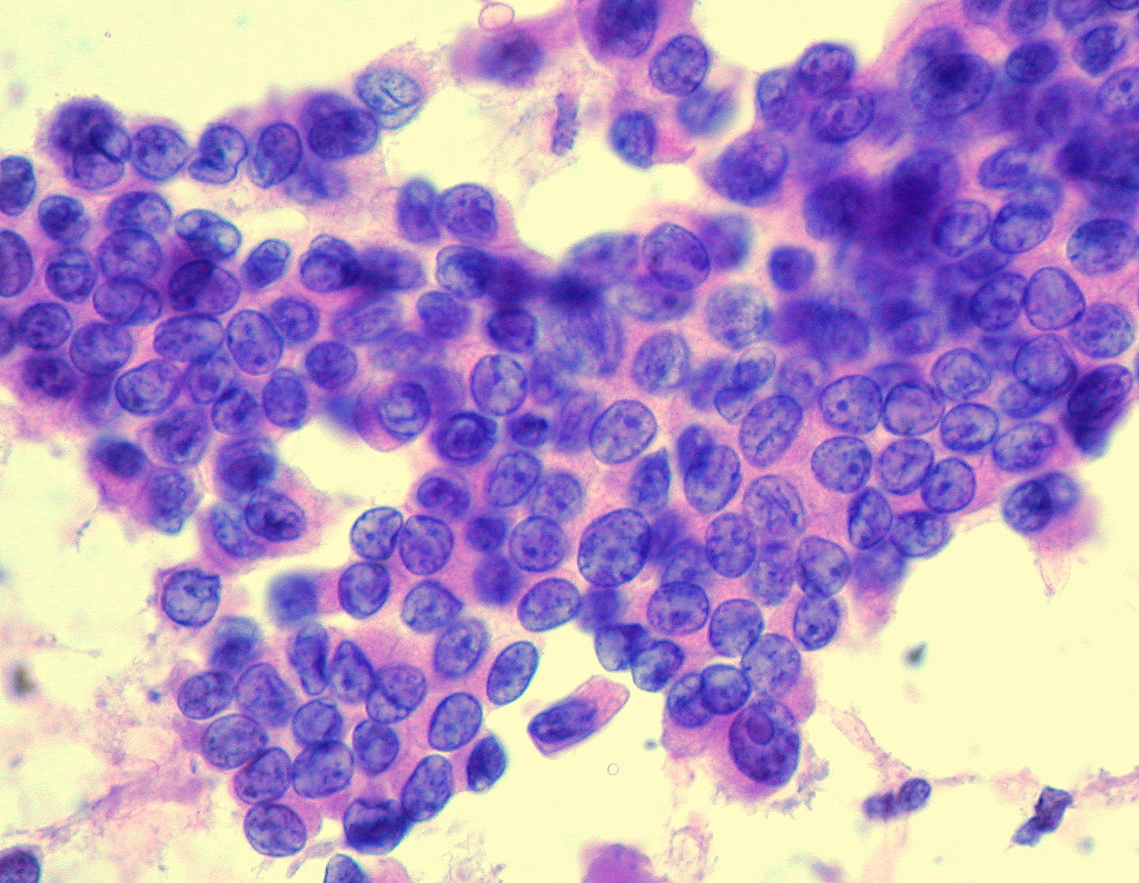 Working out how cancer spreads in healthy tissue could be a game changer 
