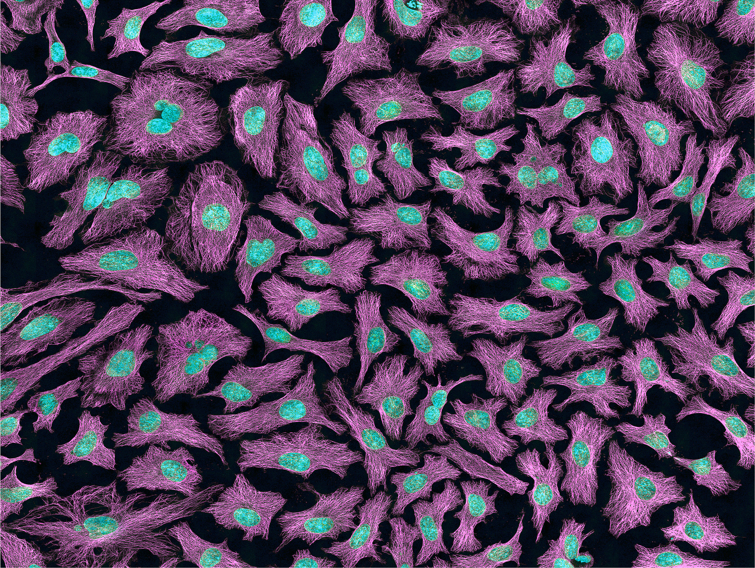 A HeLa Immortal cell line used in laboratory settings. Immortal cell lines need to lengthen their telomeres to divide indefinitely