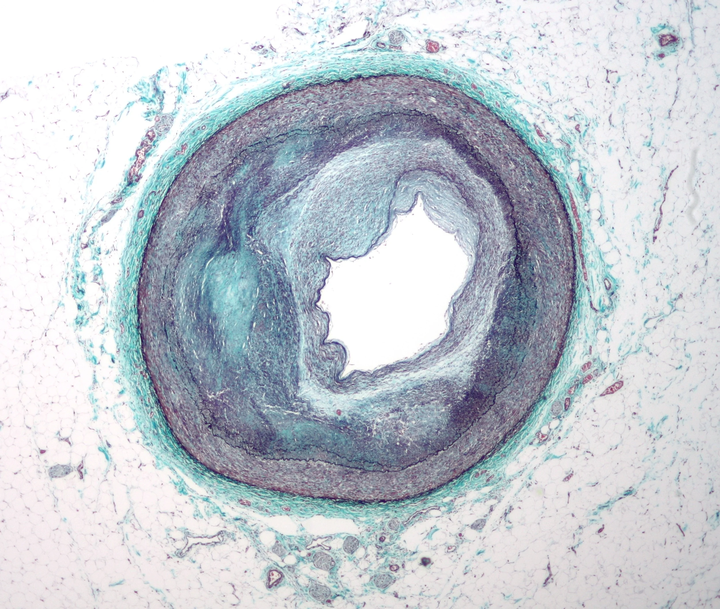 Atherosclerosis in a coronary artery, Wikimedia Commons