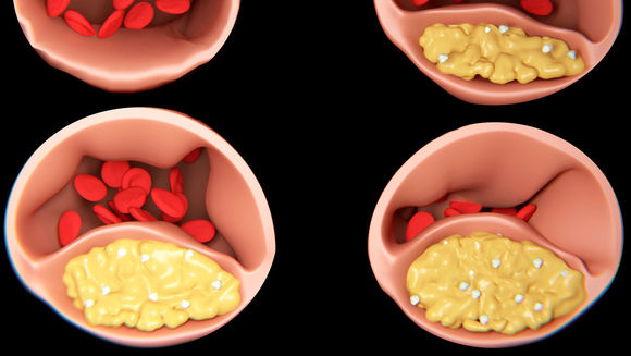 Higher blood levels of LDL coupled with oxidation lead to build up and eventually plaque formation