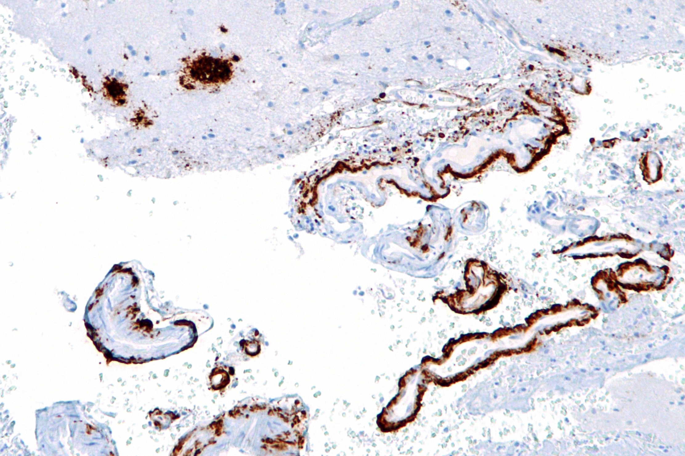 Amyloid plaque (dark) staining in the cerebral cortex