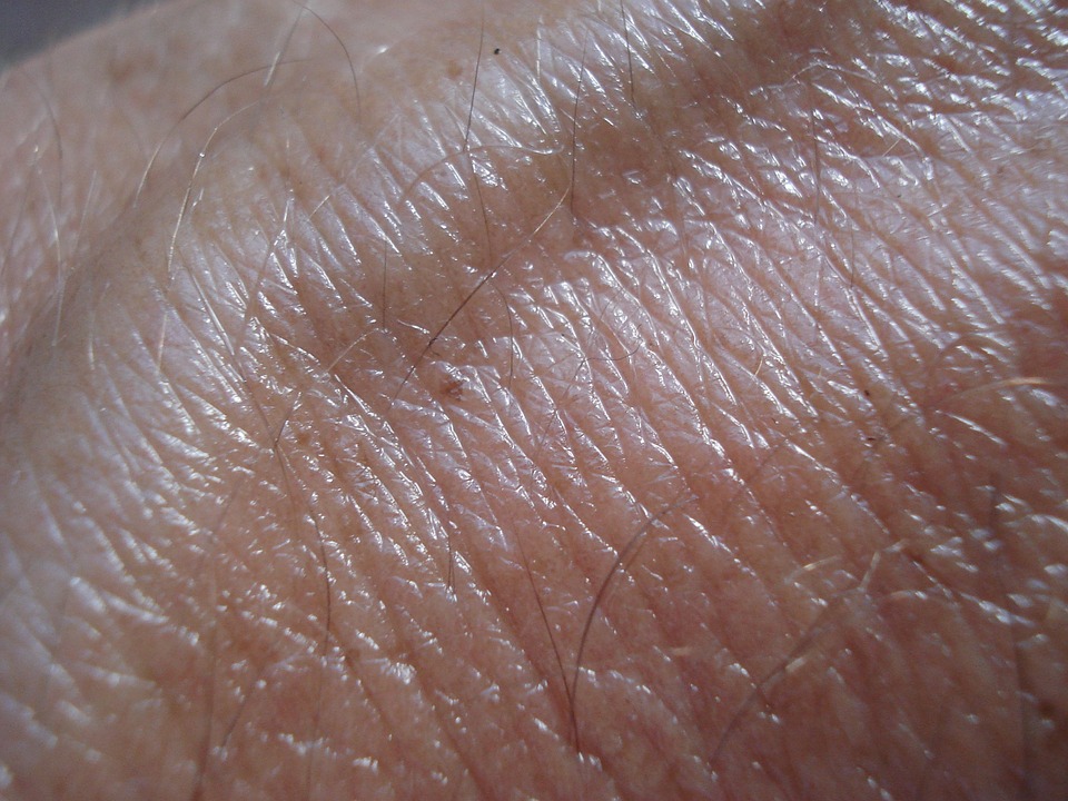 Skin cancer seemingly has a stronger genetic component 
