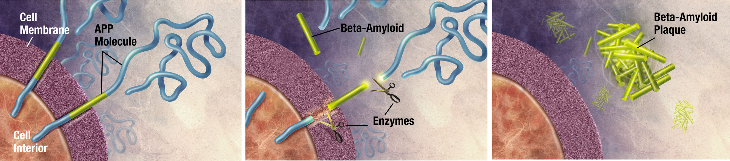 Amyloid plaque formation