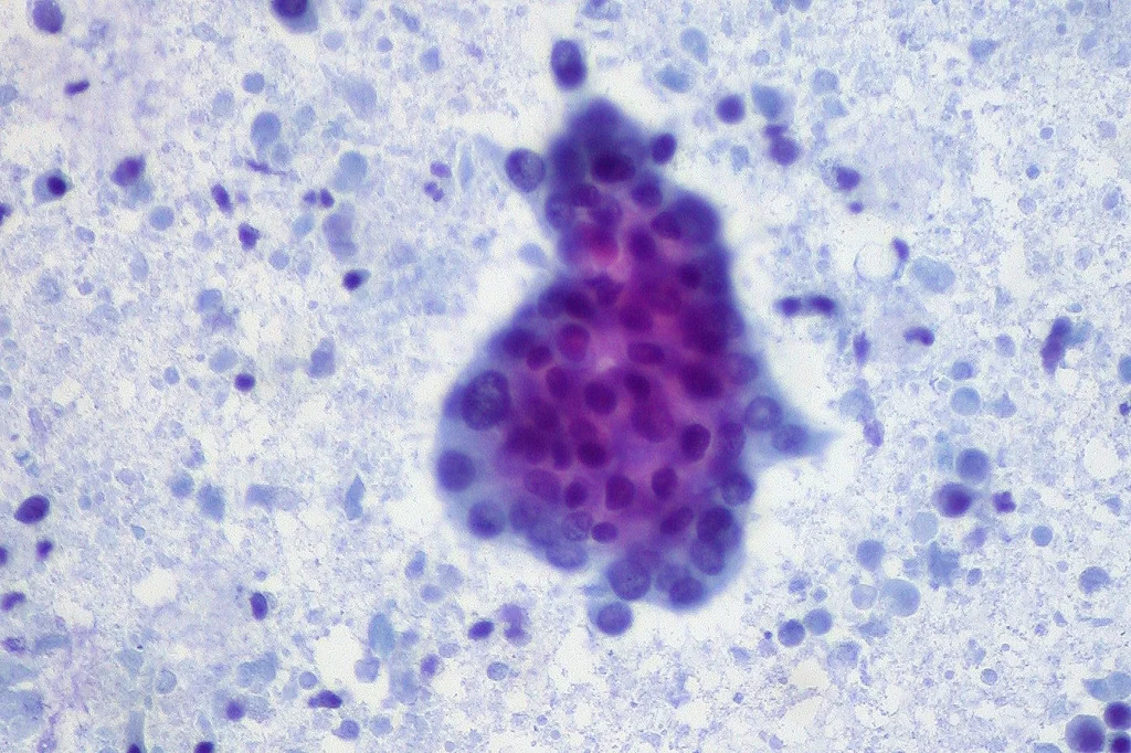Adenocarcinoma of Pancreas, FNA Credit: Ed Uthman/Flickr