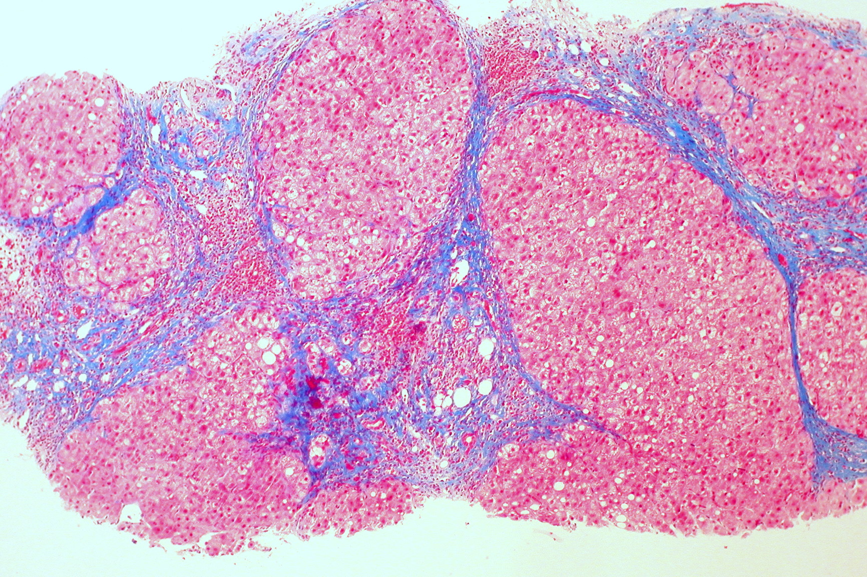 An example of liver cirrhosis. Credit: Ed Uthman