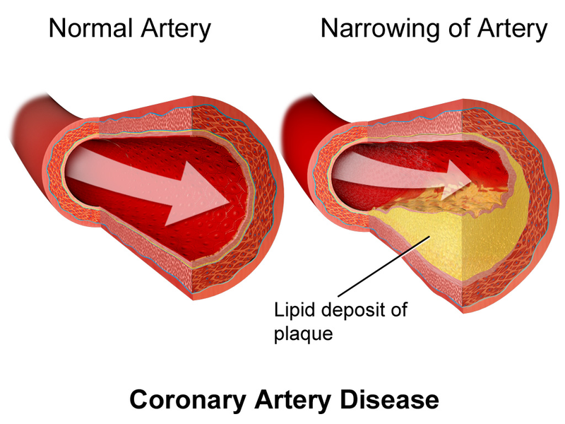 Also known as coronary artery disease, ischemic heart failure is caused by atherosclerosis and reduced blood flow to the heart