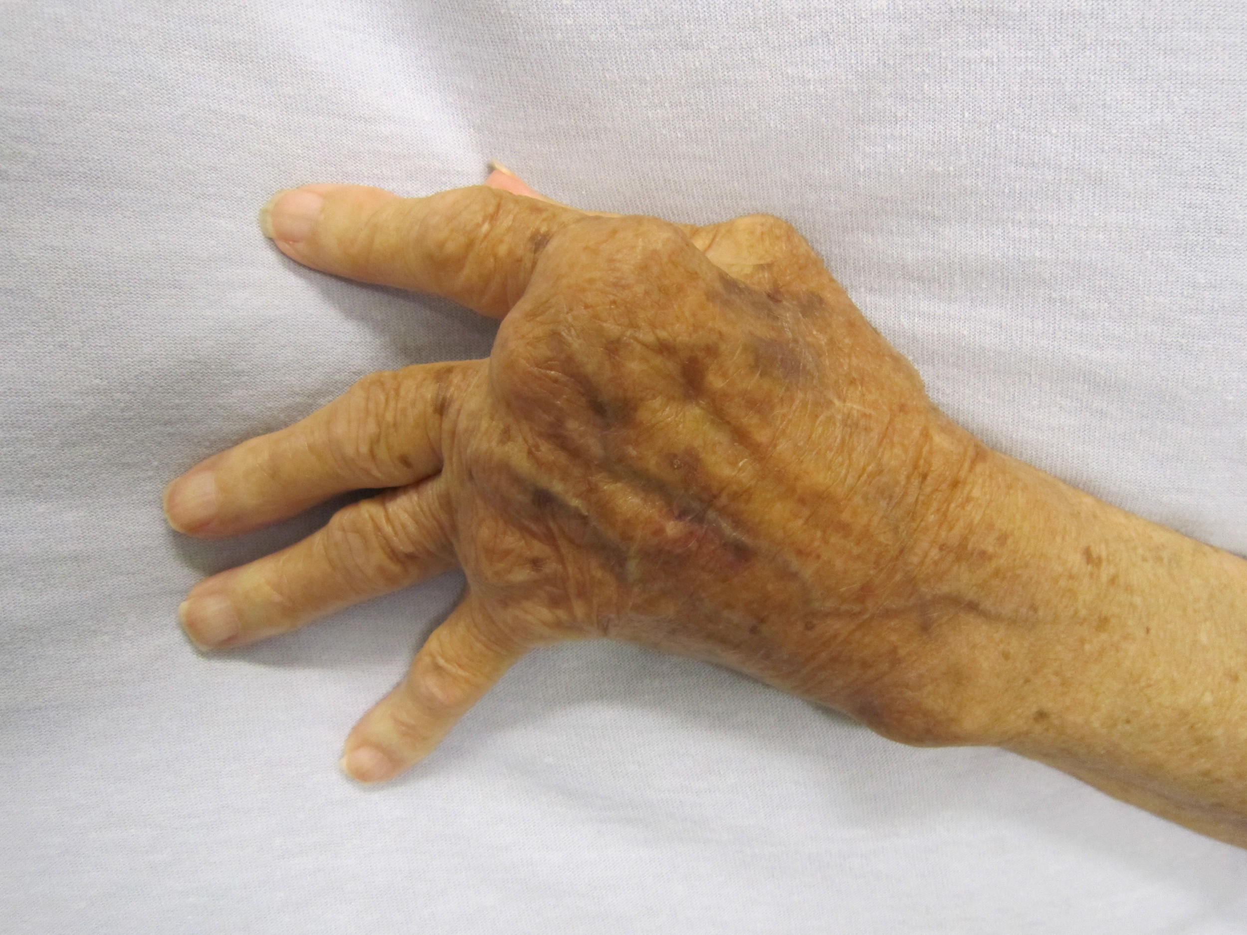 Carbamylated proteins have been tied to arthritis