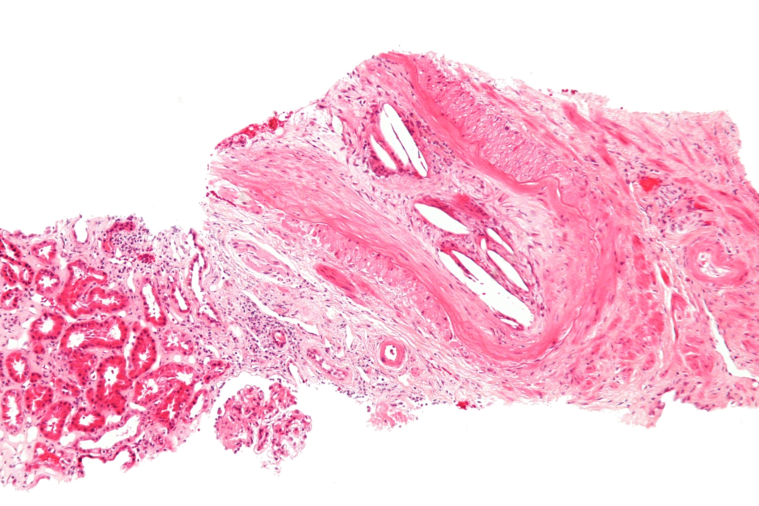 A cholesterol embolus in a medium sized artery of the kidney Credit: J Am Soc Nephrol 12 (8): 1781-7