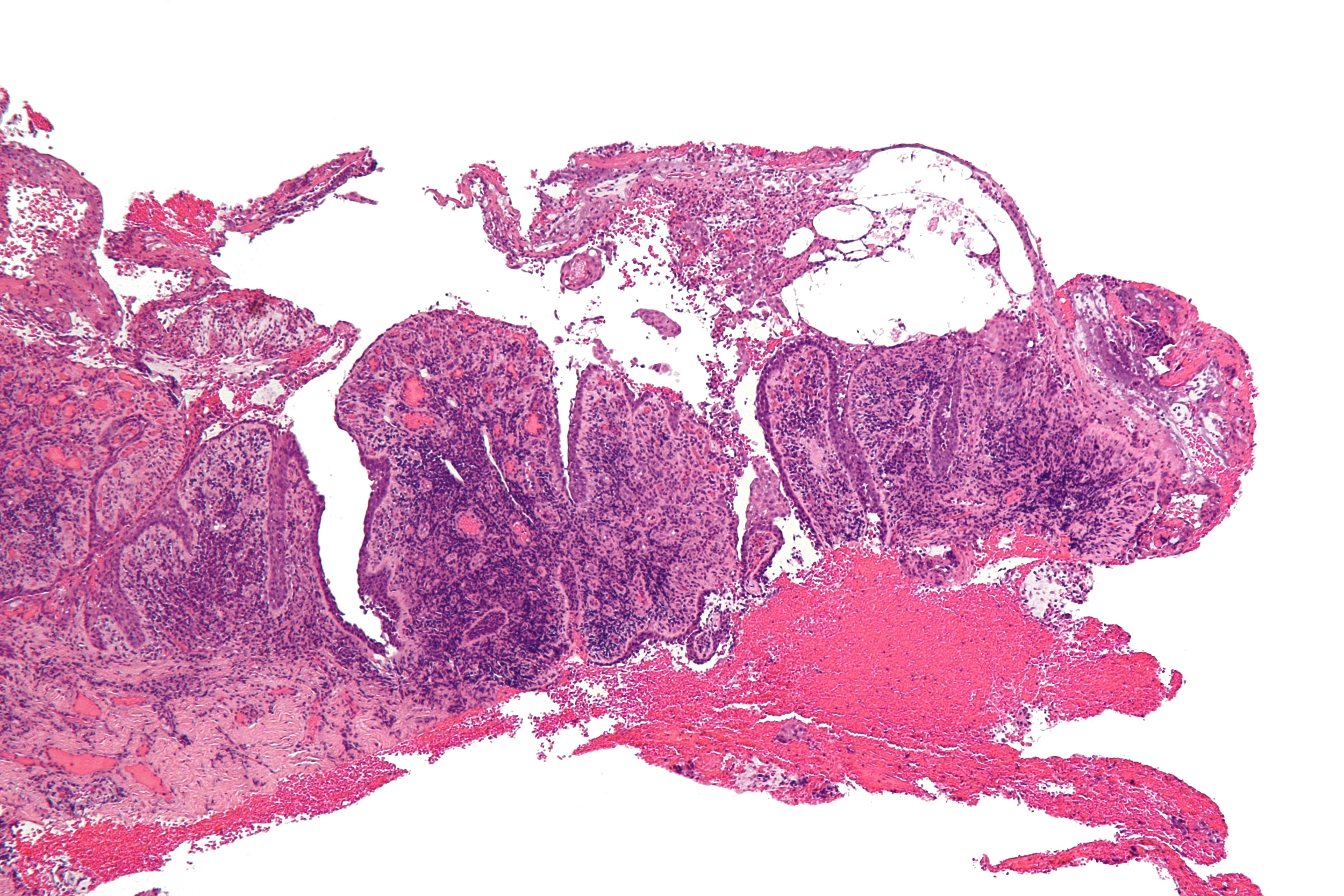 Magnification of a sample from a patient with pemphigus vulgaris