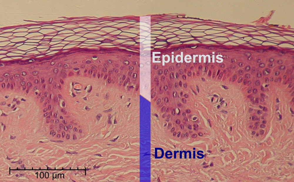 Desmoglein-3 is one of the proteins responsible for binding skin cells together effectively 