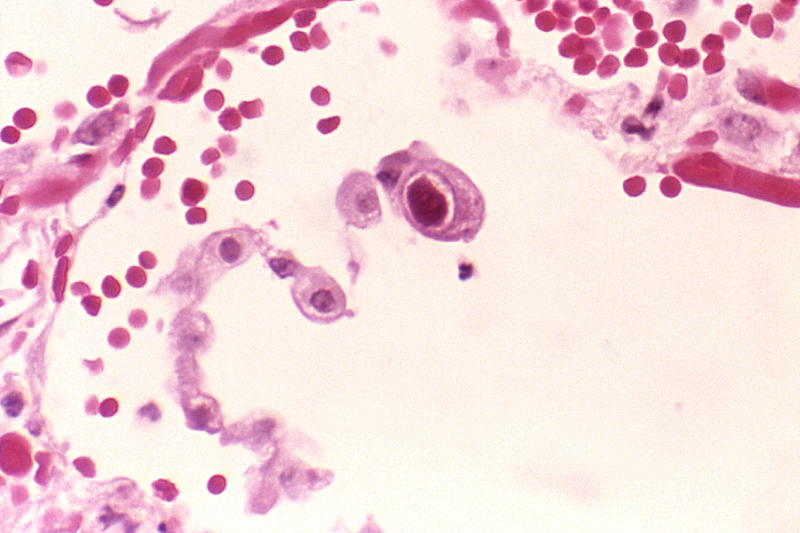 CMV infection of a lung pneumocyte