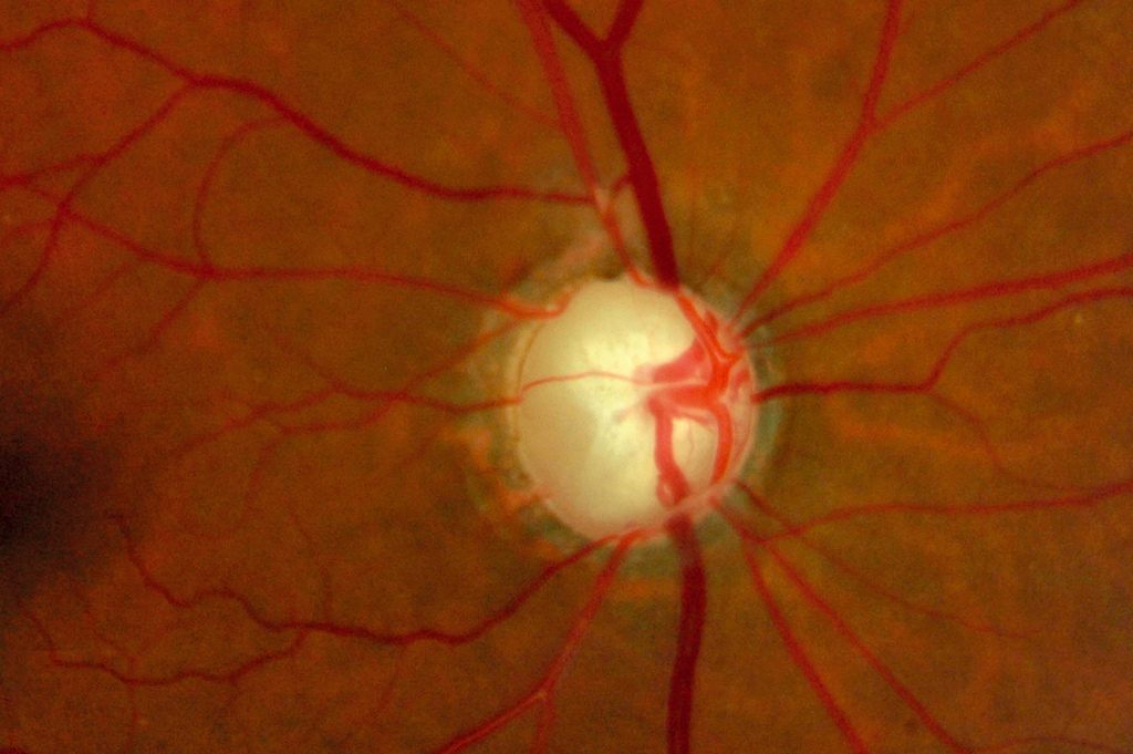 End stage glaucoma. Credit: Heiko Philippin, Community Eye Health Journal Vol. 25 No. 79.80 2012 www.cehjournal.org
