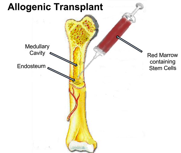 The conventional transplant strategy 