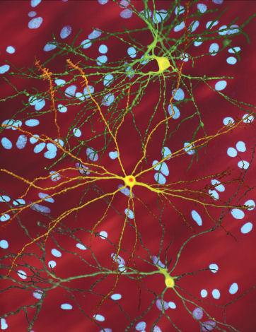 Medium spiny neurons (yellow) with nuclear inclusions (orange) typical to the disease process