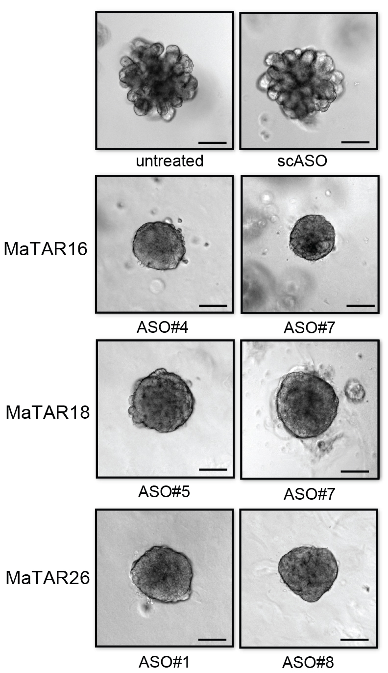 Top: a luminal B breast cancer organoid before treatment (left), and after treatment with an antisense molecule (ASO) (right). In the next 3 rows different ASOs were applied to target 3 different long non-coding RNAs overexpressed in the breast cancer type. Overall, ASO#7, targeting MaTAR16, is most effective in shrinking a "metastatic" organoid while also changing its surface appearance from bulbous to smooth. Credit: Stephen Hearn, CSHL.