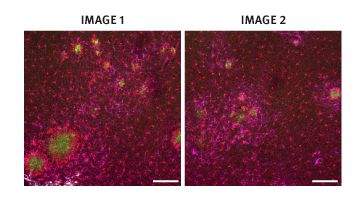Amyloid plaques are shown in green, and the glial cells are shown in red (microglia) and magenta (astrocytes). The image on the right shows a mouse cortex that received the gene therapy, with fewer amyloid plaques. Credit: Imperial College London