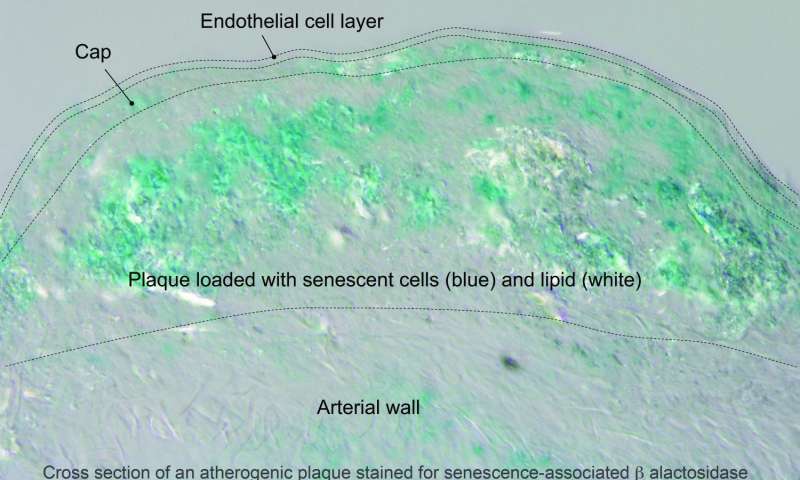 A cross section through an atherosclerotic plaque of an LDLR knockout mouse fed a high fat diet for 12 weeks. The plaque is stained for senescence-associated beta galactosidase to visualize senescent (often referred to as “zombie”) cells. Credit: Jan van Deursen and Bennett Childs