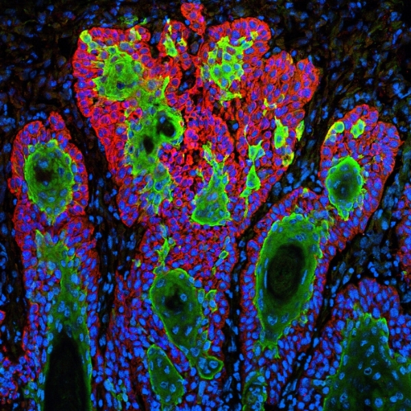 Skin cancer cells. Credit: National Institutes of Health