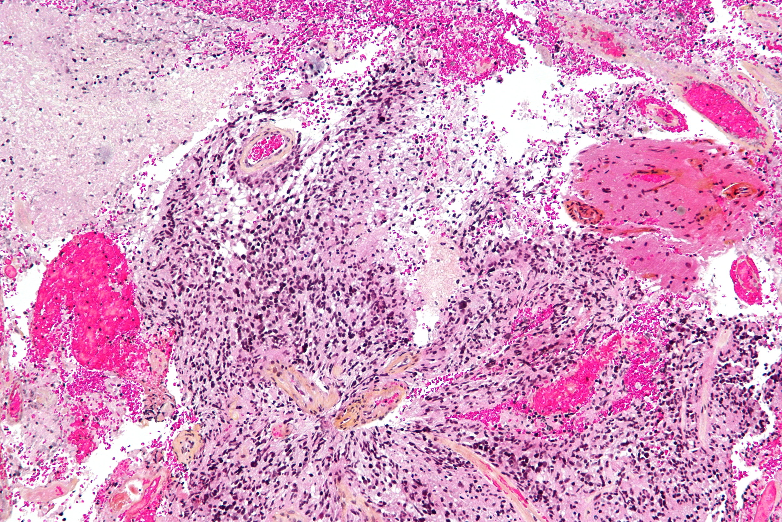  Micrograph of a glioblastoma