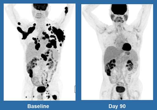 A 62-year-old man with non-Hodgkin lymphoma, at left in December 2015, and three months after treatment with Kite Pharma's experimental gene therapy. Credit: The American Society for Blood and Marrow Transplantation and Kite. (ASBMT/Kite Pharma via AP)
