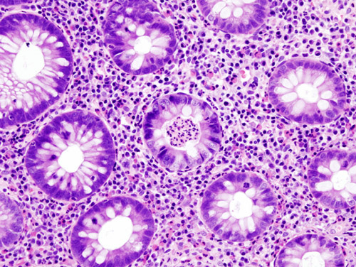 Histopathological image of the active stage of ulcerative colitis Credit: Wikimedia Commons