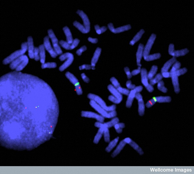 Credit: Wessex Reg. Genetics Centre. Wellcome Images