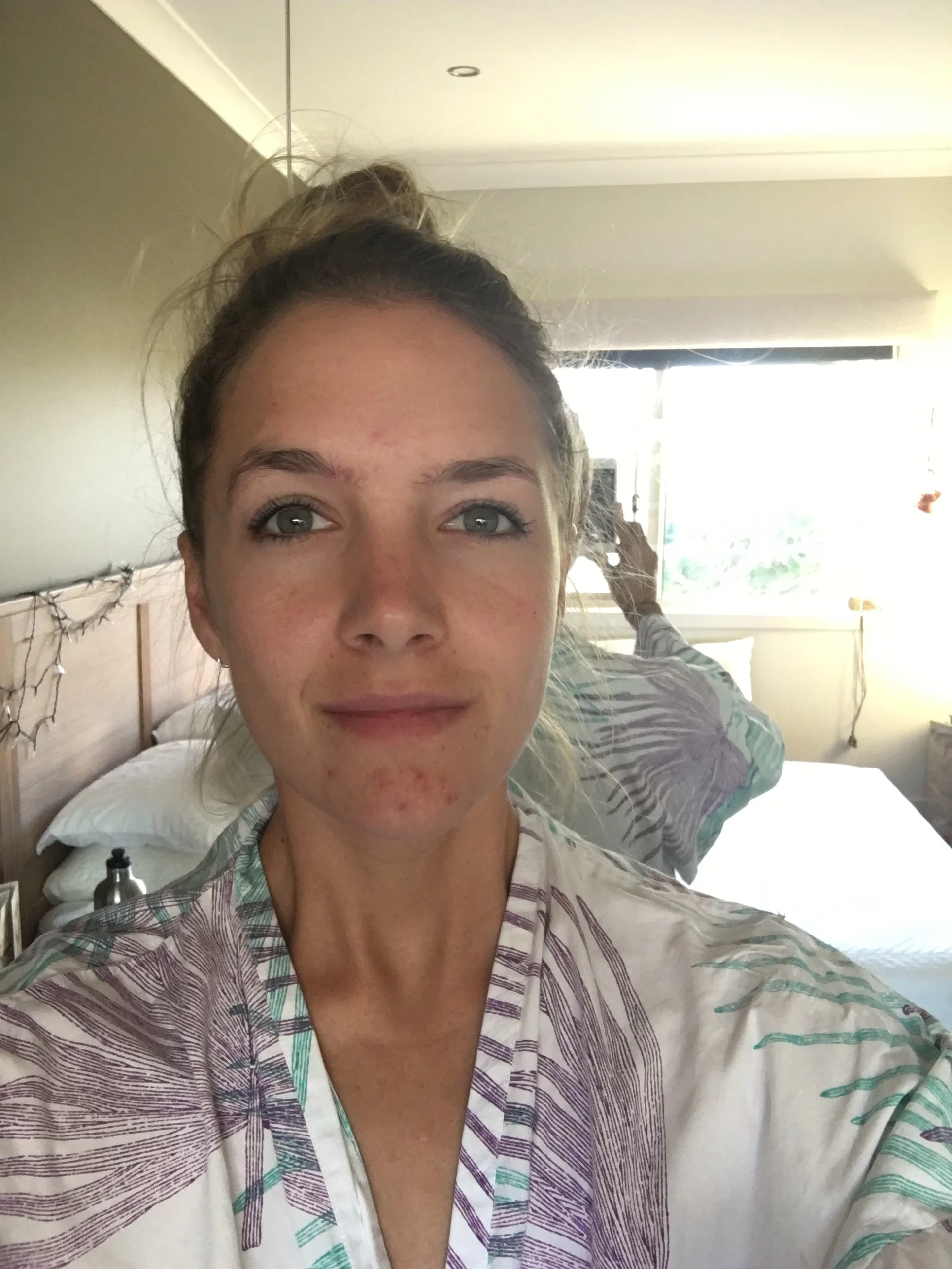 After... still a few pimples that have blown up on my chin but nothing major.. YAY! 