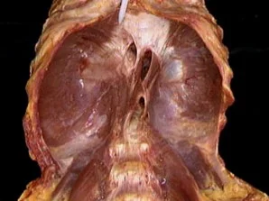 diaphragm-cadaver.jpg