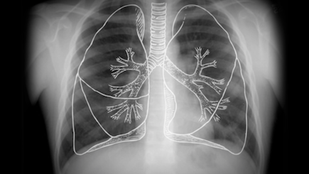 Glomus Tumor at the Tracheal Carina Client: Memorial Sloan Kettering Cancer Center Role: Producer, videographer and editor Description: Memorial Sloan-Ketterng pathologist diagnose and surgeons remove a rare glomus tumor situated at the tracheal bifurcation..