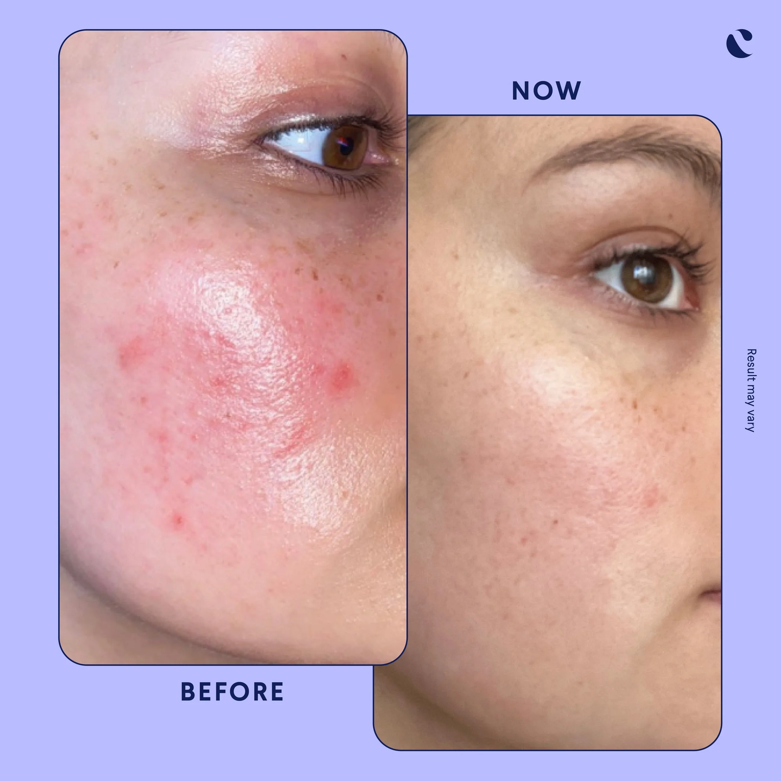 Curology Rosacea Patient Before & After Results  