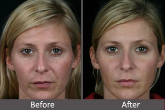 Perlane injected into nasolabial folds (smile lines), Before and after. 31 year old female