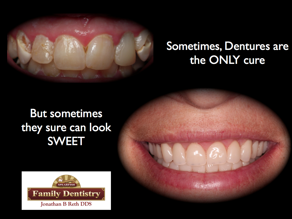 Immediate Dentures