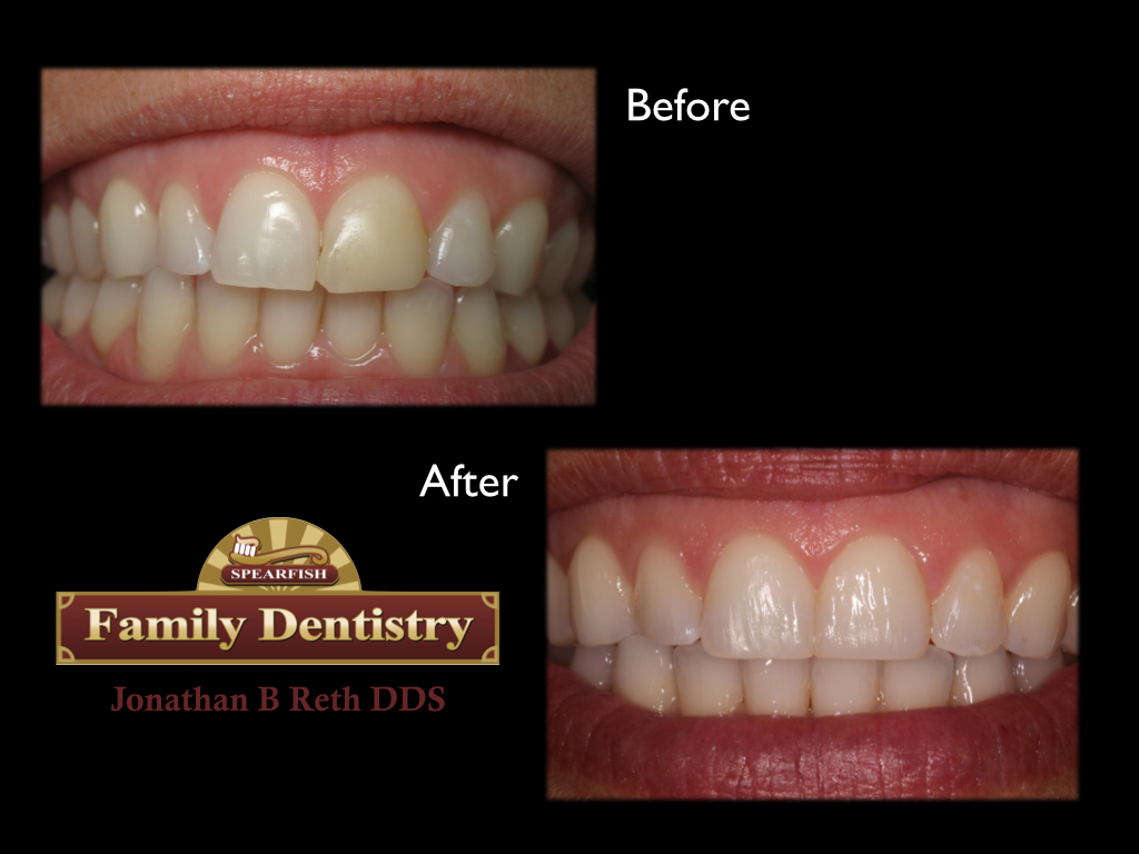 Basic Cosmetic Bleaching and Bondings