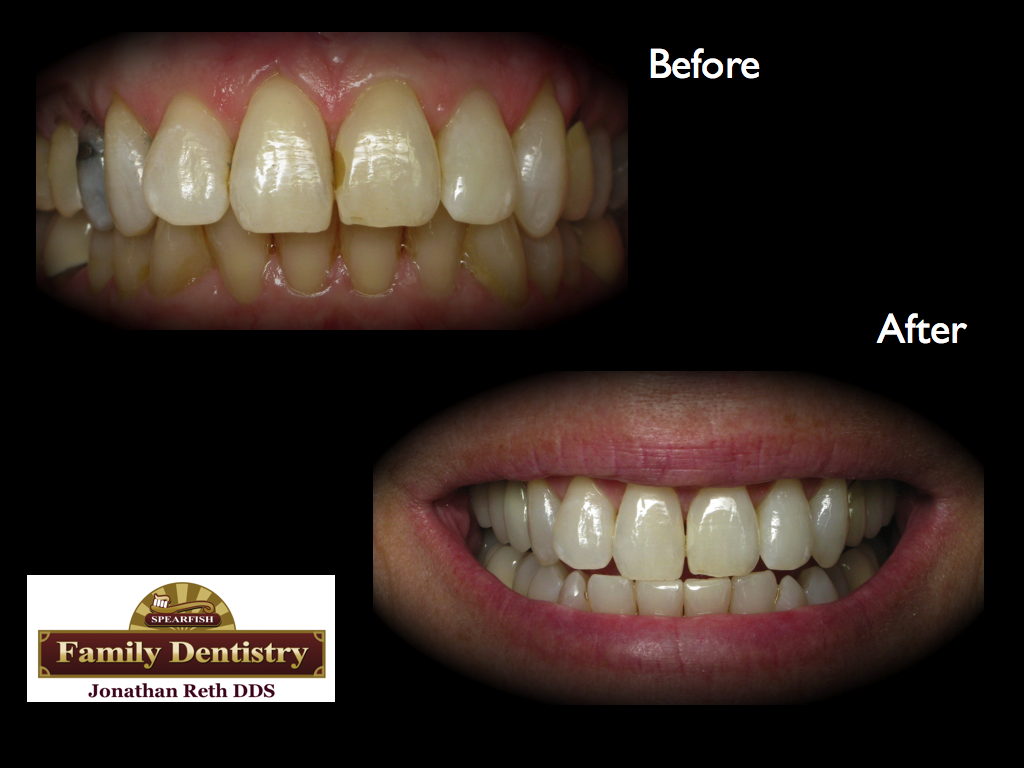 Bleaching and basic bonding and crowns